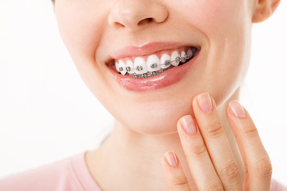 จัดฟัน Invisalign, Metal bracket and Self- ligating